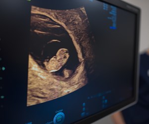 Billede af fin graviditetsskanning efter fertilitetsbehandling